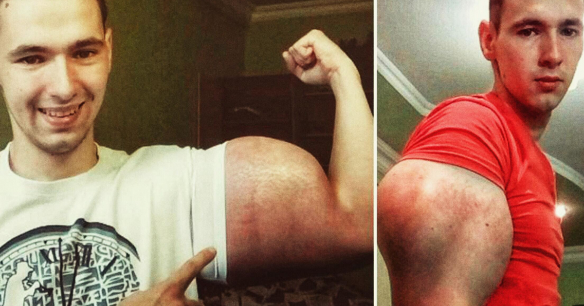 Synthol Butt